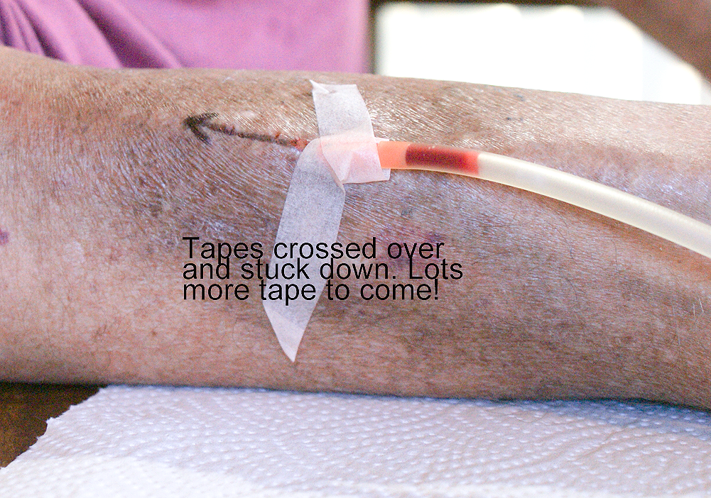 needle-taping