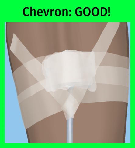 Chevron needle taping is good