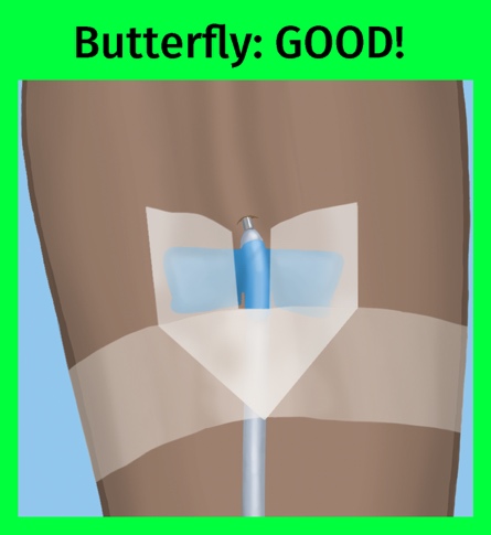 Butterfly needle taping is good