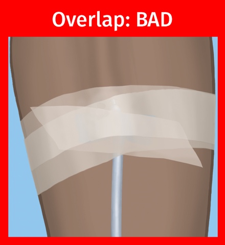 Overlap needle taping is bad